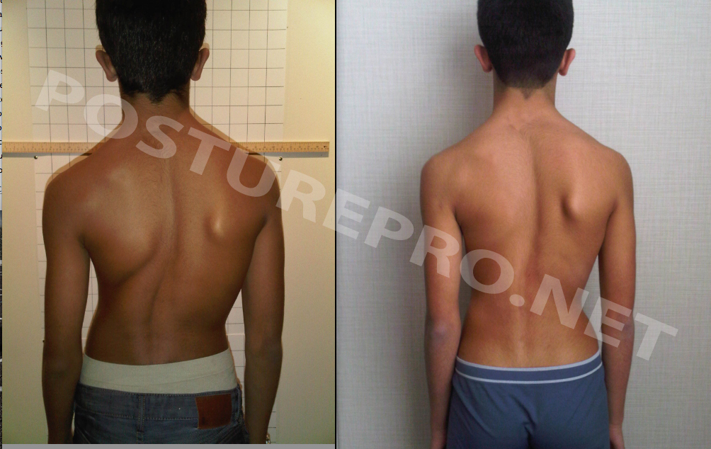 Results in 4 months with  scoliosis successfully treated with non-operative treatments. 